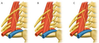 Image result for Superior Trunk Block