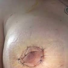 Areola reduction can only be done through surgical means unfortunately there's no way to reduce areola size without surgery. Breast Augmentation And Areola Reduction My Nipple Looks Wonky And Deformed Opinions Photos