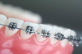 Maybe you would like to learn more about one of these? Pasang Kawat Gigi Mahal Ini Cara Menyiasatinya