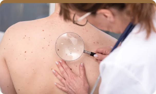 Birthmarks Removal Treatment In Dubai & Abu Dhabi | Royal Clinic