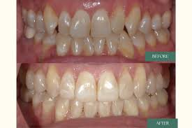Invisalign minor correction before and after treatment