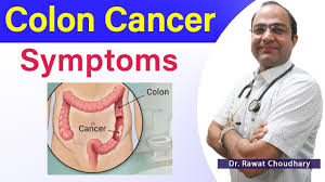 Metastatic colon cancer might cause symptoms in your liver, lungs, bones or abdomen. Symptoms Of Colon Cancer Colon Cancer Best Treatment Large Intestine Cancer Youtube