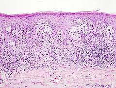 Melanom, pigment üretimi yapan hücrelerde meydana gelen bir cilt kanseri türüdür. Malignes Melanom Wikipedia