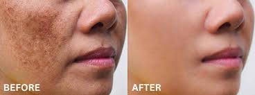 Image result for Melasma