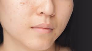 Are there any home remedies for sunspots on face? Can You Get Rid Of Dark Spots L Oreal Paris