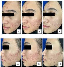 The comparable efficacy between tranexamic acid intradermal injection