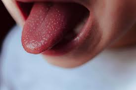 I sintomi principali della scarlattina in bambini e adulti sono: Scarlattina Neonato Come Riconoscerla Sintomi E Cura