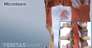 This muscle is active while running and walking and is susceptible to stress. Causes And Diagnosis Of Lower Back Strain