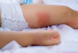 Allopathic treatments for eczema include antihistamines and steroids. 10 Useful Home Remedies For Baby Eczema