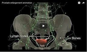 Prostate Enlargement Development Bph News