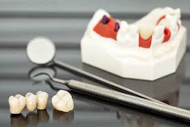 We did not find results for: What To Do If You Have A Chipped Or Broken Crown Absolute Dental