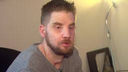 Katie Stubblefield: Face transplant gives suicide survivor a 'second  chance'