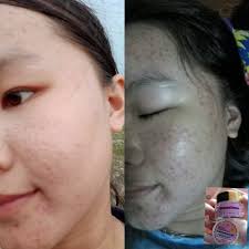 yog koj muaj pob muaj hiav txhob ua siab deb qhib siab lo nrog peb siv xuv  bemae cream no tau nawb 👉Siv zoo heev li 👈ລີວີວຈາກຕົວເອງແລະລູກຄ້າ