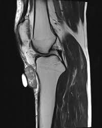 Image result for Leiomyosarcoma