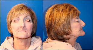 Narrative Review: Submental Artery Island Pedicled Flap, Indications, Tips,  and Pitfalls