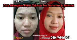 Segala parut chicken pox yang menjengkelkan itu telah lenyap sama sekali. Chicken Pox Cacar Air Archives Provide Network