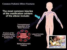 A problem with your vehicle's brakes can be scary. Common Pediatric Elbow Fractures Everything You Need To Know Dr Nabil Ebraheim Youtube