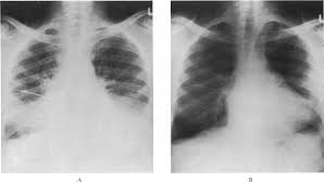 Image result for Intestinal Enteropathy