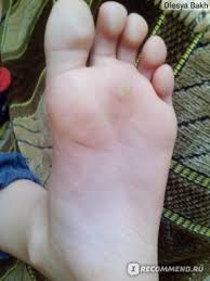 как вывести сухой мозоль со стержнем на пальце ноги Udalenie Papillom Borodavok I Rodinok Krioterapiej Zhidkim Azotom Udalenie Sterzhnevoj Mozoli Nam Azot Ne Pomog Poka Ili Ne Proshlo I Polgoda Kak Mozolina Poshla Na Ubyl Otzyvy Pokupatelej