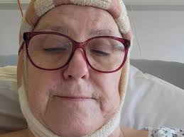 Hertfordshire mum fears she looks like 'Frankenstein's monster' as skin  cancer leaves bald 'craters'