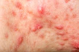 Image result for dermatitis contacta allergica