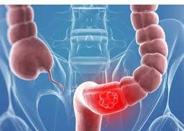 Il colon, ovvero il tratto terminale dell'apparato digerente che precede l'intestino retto, è spesso soggetto a delle infiammazioni, le quali si possono manifestare in diversi modi. Tumore Al Colon Come Prevenirlo Alimento Da Mangiare Per Evitare Il Tumore Affaritaliani It
