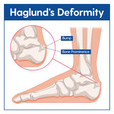 An example is haglund's deformity, a condition caused by a bump on the back of the heel. Haglund S Deformity Causes Treatment My Footdr