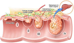 They filter the lymph as it drains back to the bloodstream. Colorectal Cancer In Malaysia