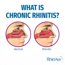 Image result for Rhinitis