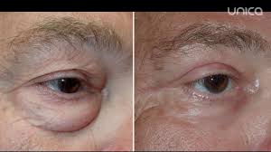 Pana la operatie am trecut cateva in acest pret intra testari la diferite aparate care va testeaza refractia, tensiunea globului ochiular, grosimea corneei. Chirurgul Plastician Anatolie Taran Te AjutÄ Sa Scapi De Pungile Sub Ochi Youtube