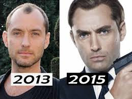 In cases where you have more than one contributing factor, the cumulative effect can be more severe hair loss. Did Jude Law Get A Hair Transplant Or Not Analysis By Matt Dominance