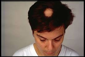 Eating disorders (such as anorexia, bulimia). Alopecia Areata Baldness And Hair Loss Causes Symptoms And Treatment Patient