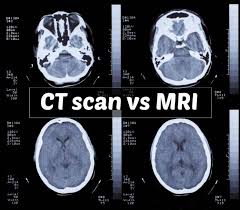 Http Www Careyourpuppy Com Ct Scan Vs Mri Mri Epilepsy Ct Scan