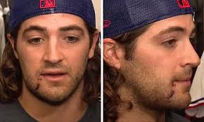 Texas Rangers' Josh Smith receives SIX stitches but feels 'pretty good'  after being hit in the FACE