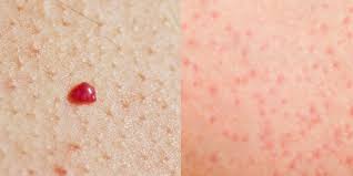 Small red spots across your back, chest or abdomen. What Do Red Spots On Skin Mean 13 Skin Spots Bumps Pictures