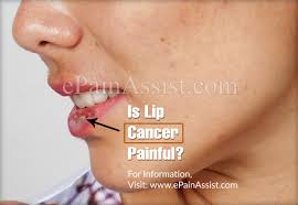 The early stage of lip cancer may be asymptomatic. Is Lip Cancer Painful