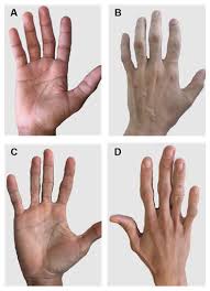 Inherited lipodystrophy is actually a group of related illnesses. Congenital Generalized Lipodystrophy