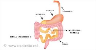 Image result for Intestinal Atresia