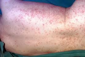 Image result for skin rash acute hiv infection