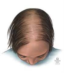 Here, beauty blogger amy chang shares the regimen that worked. Hair Loss In Women Causes Treatment Prevention