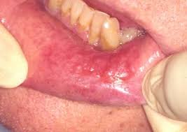 Image result for lichen planus on tongue)