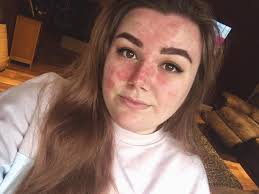 just wanted to share a small success story, in the first photo May 2019. I  was covered head to toe in pso, constantly using steroid creams, trying all  kinds of crazy diets