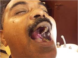 Téléchargez de superbes images gratuites sur pillars. Verroucas Xanthoma Of Faucial Pillar A Case Report