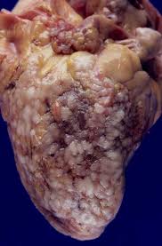 Mesothelioma is a global problem, largely related to the previous use of asbestos products. Pathology Images Gross Pathology Histopathology Histology
