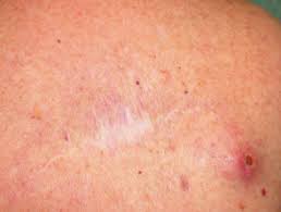 Here are 10 more facts about prostate cancer. Cutaneous Metastasis Dermnet Nz
