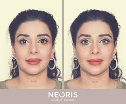 Et la couleur des yeux la plus rare est la couleur jaune, qui résulte de la présence d'un pigment appelé mais depuis 2011, la correction au laser s'est développée, inventée par le dr gregg homer, aux chez certaines personnes, les deux yeux changent de couleur. Neoris Before After Meet Roxy And Her Aqua Blue Facebook