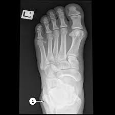 Hello and welcome to the pain management forum. Foot X Ray Labeling Questions Radiology Case Radiopaedia Org