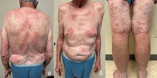 Image result for Leprosy