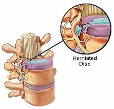This damaged disc puts pressure on either the whole spinal cord or on a single nerve root, which means that a slipped disc pain can be experienced both in the area of the protruding disc as well as the body part that the affected (pressed) nerve transmits to. Pinched Nerve Herniated Disc From Car Accident