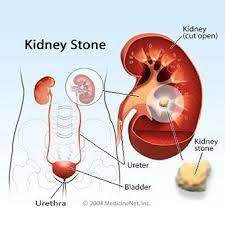 Kidney Stones And Those That Cause Side Effects Keephealthyalways Com Reliable Health Advice A Kidney Stones Remedy Nursing Care Plan Natural Home Remedies